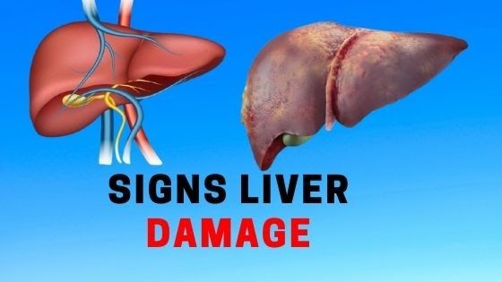 Signs of Liver Cancer in Women101: Symptoms, Pain, and Skin Rash