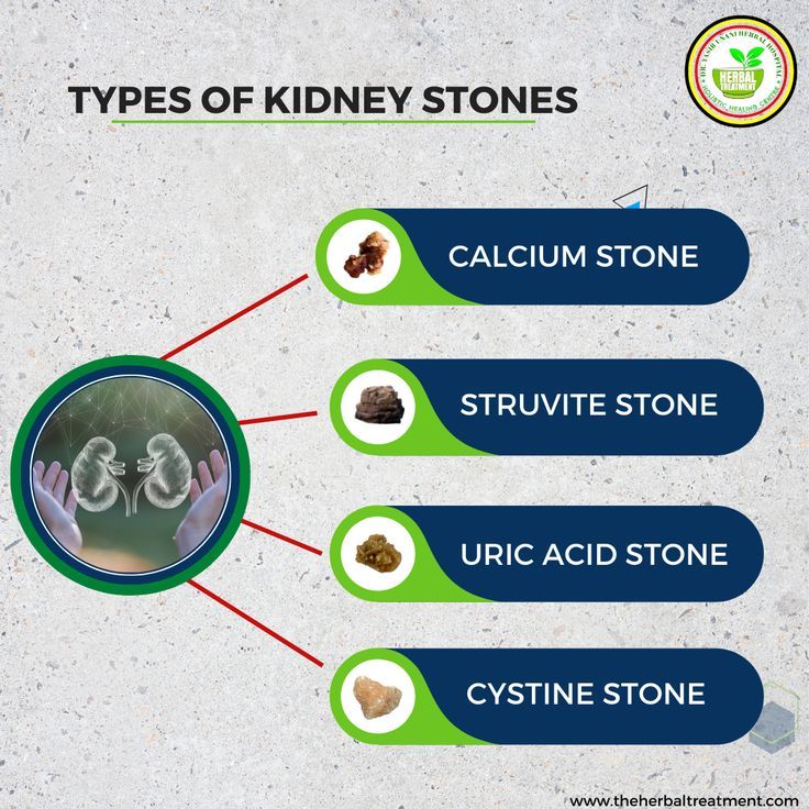 Understanding Kidney Stones: Causes, Symptoms, and Effective Treatment Options